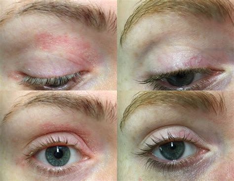 Seborrheic Dermatitis Under Eyes