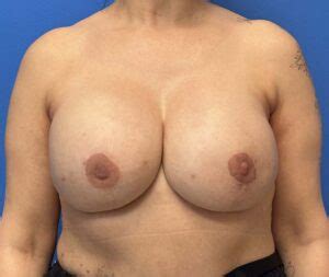 Breast Reconstruction Austin Tx Dr Weinfeld