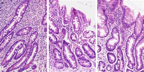 Histopathology And Molecular Pathology Of Intestinal Metaplasia