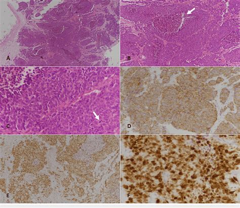 Poorly Differentiated Neuroendocrine Carcinoma Of Primary Lung Origin Download Scientific