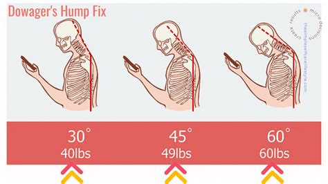 How To Fix A Hunched Neck