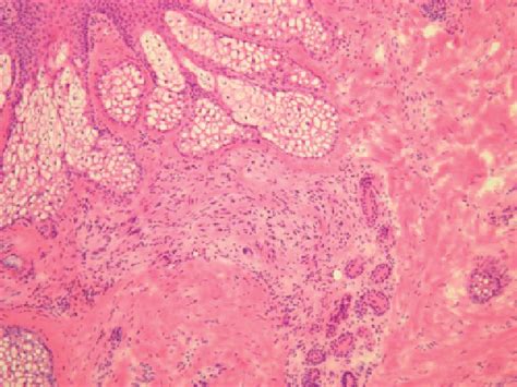 Figure 1 From Cellular Neurothekeoma Treated With Mohs Micrographic Surgery Semantic Scholar