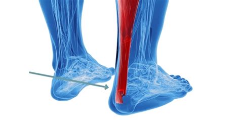 Tendon Yaralanmas Nas L Tedavi Edilir Tendon Kopmas Tedavisi Nas L