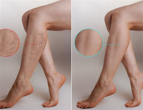 What Causes Veins To Be More Visible In Legs Dr Lawrence Schmetterer