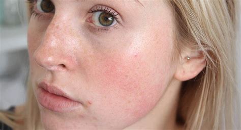 Castor Oil Uses Rosacea Skin Care Rosacea Acne Treatment Skin Disorders