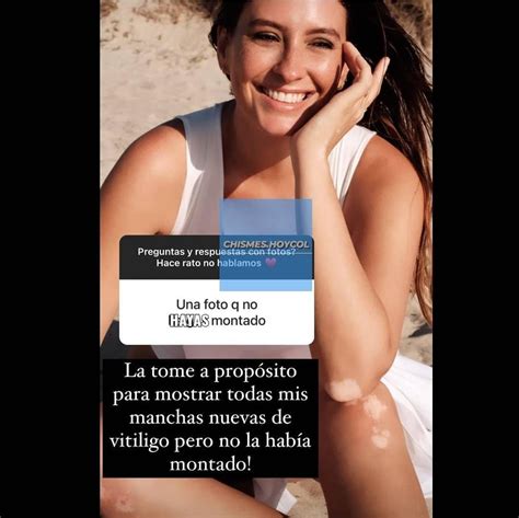 Taliana Vargas mostró en fotos cómo avanza su vitiligo Infobae