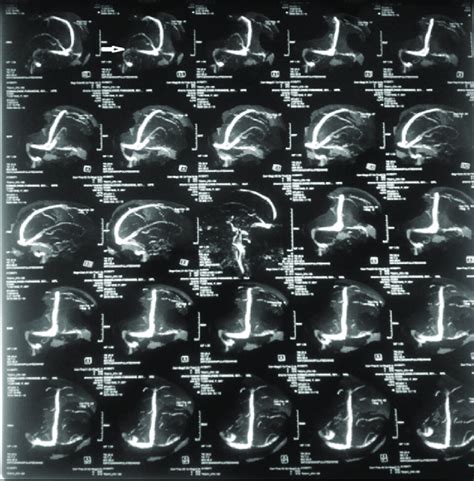 Brain MRV of the patient. | Download Scientific Diagram