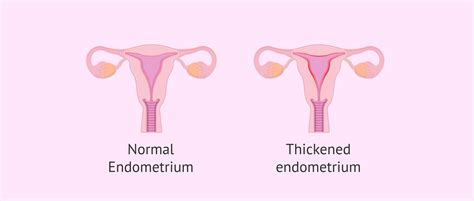 Normal endometrium and endometrium with hyperplasia