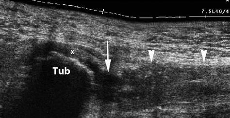 Hamstring Ultrasound