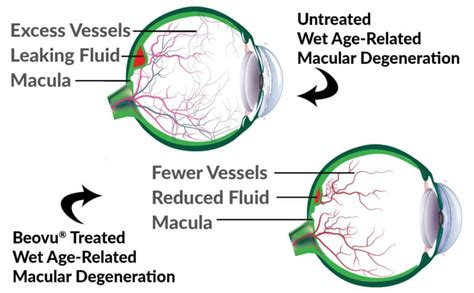 New Macular Degeneration Drug Available The Eye Institute Of West Florida