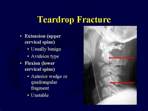 Subaxial Cervical Spine Trauma Lisa K Cannada Md