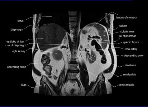 Anatomy Human Abdomen MRI Abdomen Coronal Anatomy Free Cross