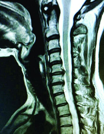 Preoperative T2 Weighted Sagittal MRI Revealing Disc Prolapse And