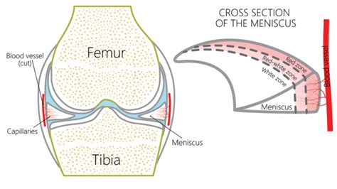 Meniscus Tear Recovery Tme Without Surgery - Regenexx