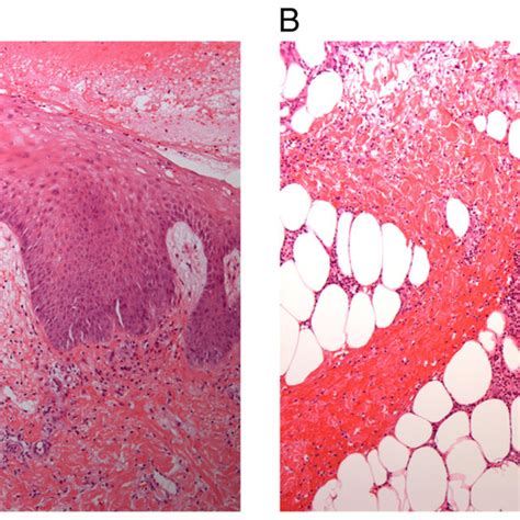 Histological Images Of A Skin Biopsy Specimen Hematoxylin Eosin