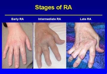 Rheumatoid Arthritis - Physiopedia