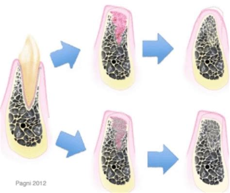 Reducing Alveolar Ridge Resorption after Tooth Extraction - ARIADentalEd