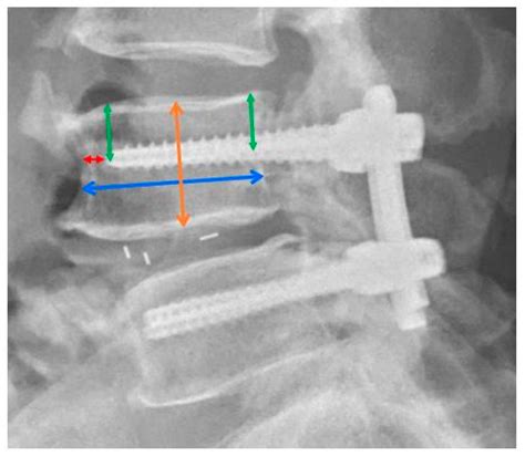 Jcm Free Full Text Robot Assisted Pedicle Screw Placement Led To