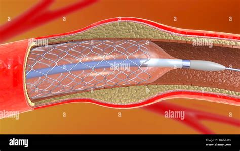 D Illustration Of Stent Implantation For Supporting Blood Circulation