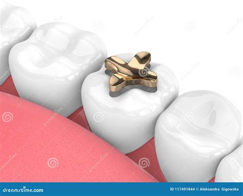 D Render Of Teeth With Dental Inlay Golden Filling Stock Illustration