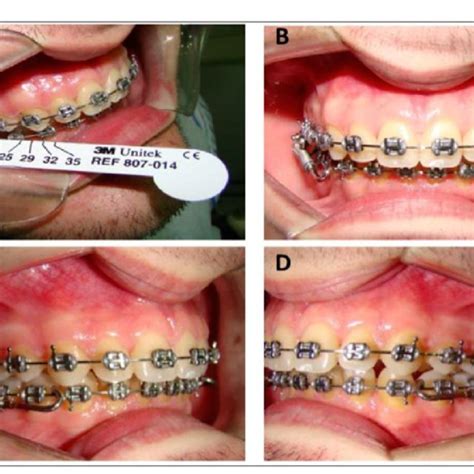 Pdf Optimization Of Class Ii Malocclusion Treatments Using The Forsus™ Fatigue Resistance