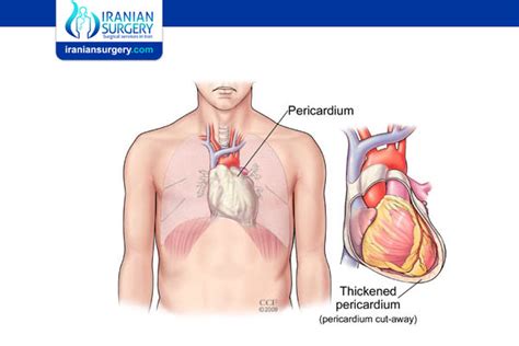 Pericardiectomy | Iranian Surgery