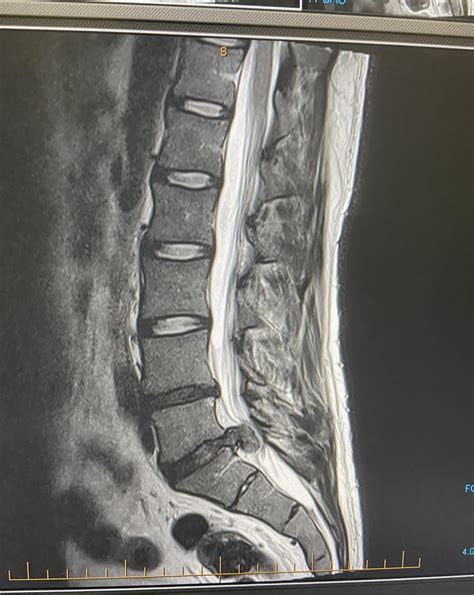 My L5/S1 Disc Extrusion! : r/Sciatica