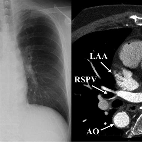 Chest Xray And Computed Tomography Showing Dextrocardia With Complete