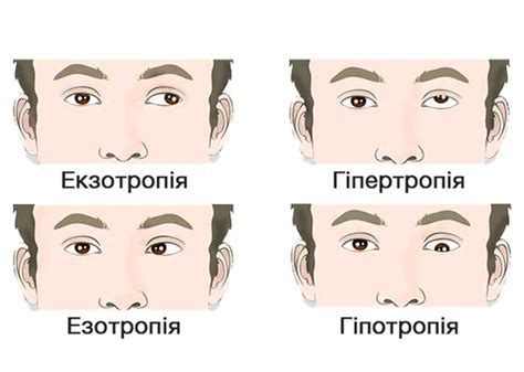 Амбліопія