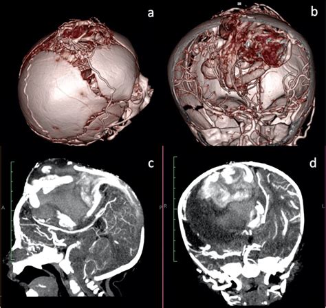 Computed Tomography Angiography Cta With 3d Reconstruction A 3d