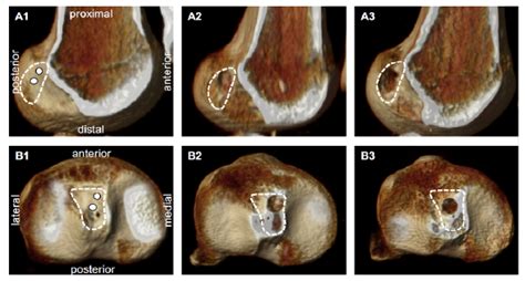 Scielo Brasil Anteromedial Or Central Anatomic Acl Reconstruction