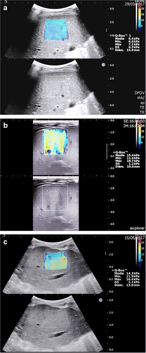 Elastography Color Maps A Two Dimensional Shear Wave Elastography 2 D Download Scientific