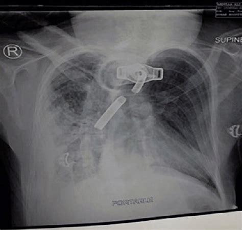 Tracheostomy X Ray