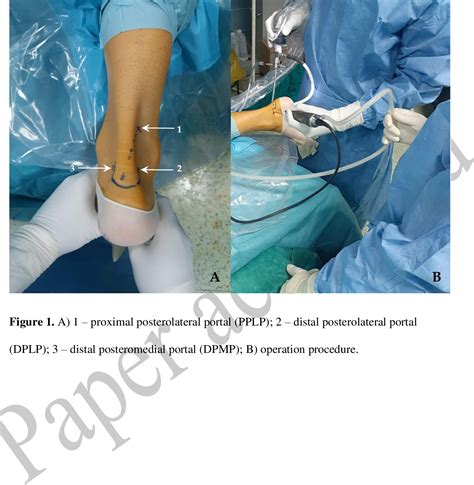 Figure 1 From Resection Of Haglunds Deformity Using The Arthroscopic