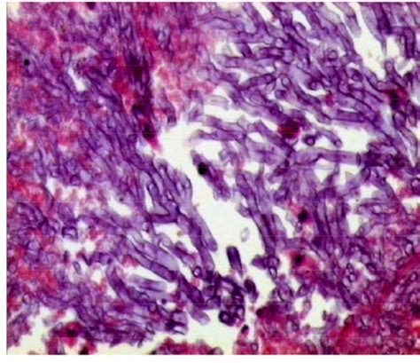 Reproductive Pathology Flashcards Quizlet