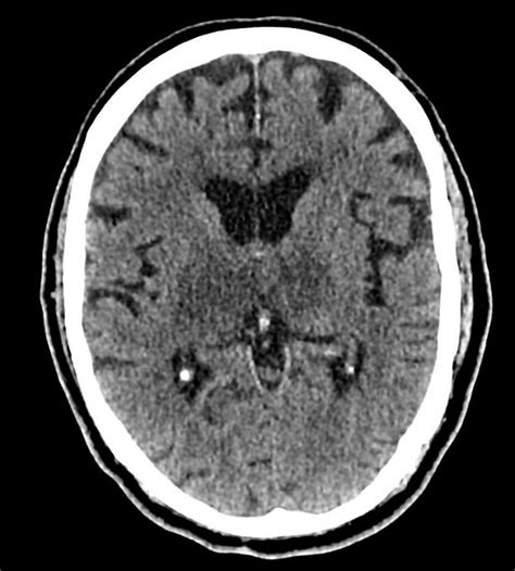 Deep Cerebral Venous Thrombosis Pacs