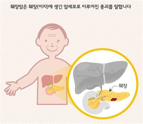 췌장암 초기증상은 췌장의 위치와 구조를 알아보자