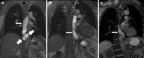 Postoperative Appearance After Nissen Fundoplication On Mri In Three