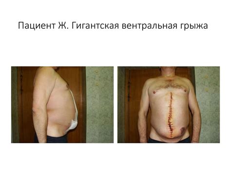 Наружные грыжи живота и принципы грыжесечения - презентация онлайн