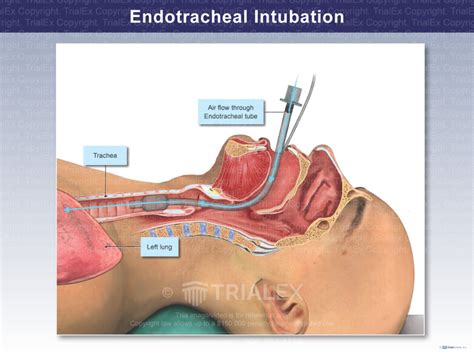 X Endotracheal Intubation Anatomy Exhibits The Best Porn Website