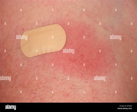 Swelling Hi Res Stock Photography And Images Alamy