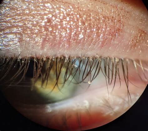 Demodex blepharitis (DB) and its symptoms | EyelidCheck.com