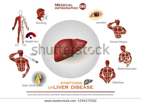 Symptoms Liver Disease Infographic 库存矢量图（免版税）1196172502 Shutterstock