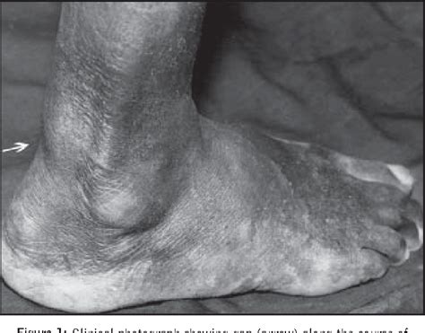 Figure 1 from Achilles tendon enthesopathy in ochronosis. | Semantic Scholar