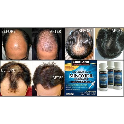 Kirkland Minoxidil 5 Extra Strength Men Hair Regrowth Solution 7774721