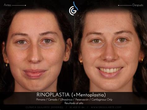 Rinoplastia Con Mentoplastia Galer A De Fotos Casos Reales