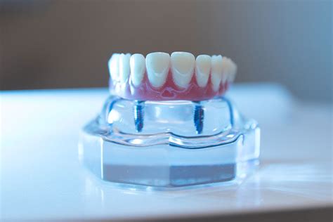 Implant Supported Dentures Louisville KY Advanced Implant Centers