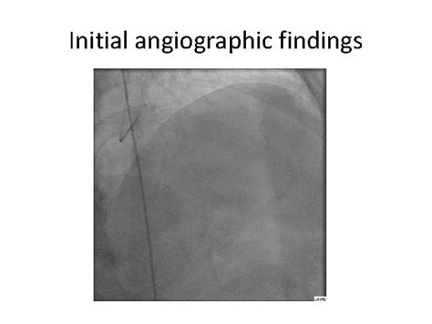 Use Of The Novel Orbital Atherectomy System For