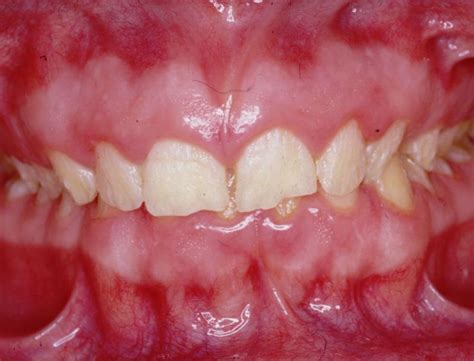 Anomalies Of Dental Hard Tissues