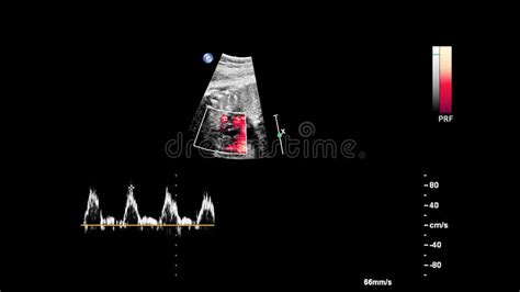 Ultrasound Scherm Met Foetale Echocardiografie Stock Afbeelding Image